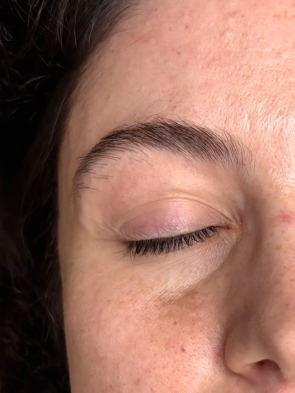 Avant le browlift : sourcil clairsemé, poils orientés vers le bas, paupière fermée